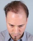 Before Hair Transplant&nbsp;Revision
